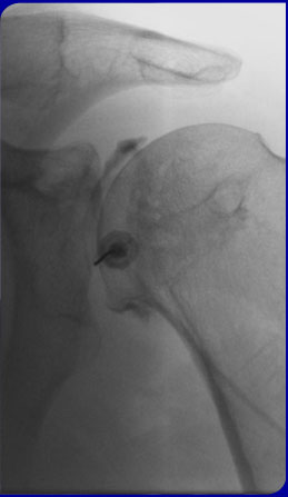 X-Ray
