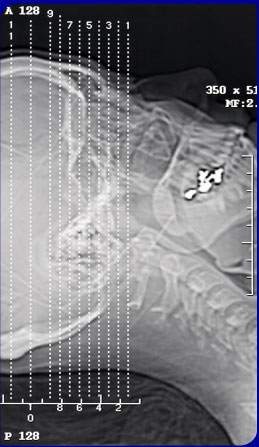 X-Ray