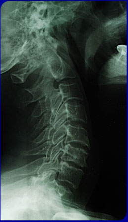 X-Ray
